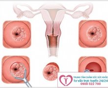 Viêm lộ tuyến cổ tử cung là bệnh gì?