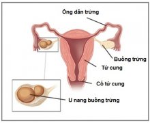 Cách điều trị u nang buồng trứng trái