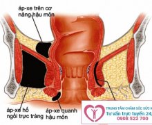 Các dấu hiệu của bệnh áp xe hậu môn