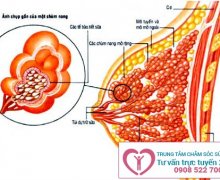 Áp xe vú- Đừng chủ quan!