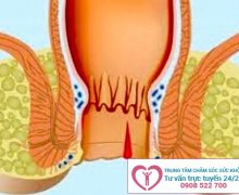 Chảy máu hậu môn là biểu hiện của bệnh gì?