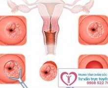 Làm sao để điều trị viêm lộ tuyến cổ tử cung