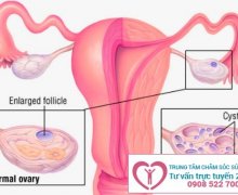 Nguyên nhân gây bệnh buồng trứng đa nang