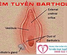 Phương pháp điều trị viêm tuyến Bartholin hiệu quả