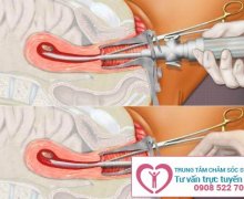 Thai 2 tháng tuổi có phá được không?