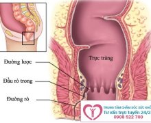 Hậu môn ẩm ướt có mùi hôi là bệnh gì?