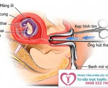 Hút thai có nguy hiểm không?