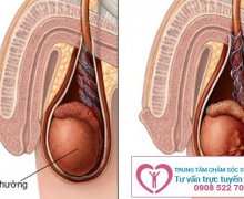 Cảnh báo các bệnh nguy hiểm khi tinh hoàn nổi cục cứng