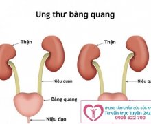 Đi tiểu đêm nhiều lần là bệnh gì?