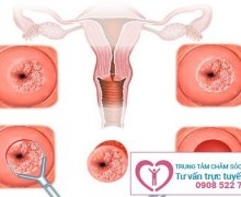 Viêm lộ tuyến cổ tử cung là gì ?