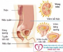 Dấu hiệu nhận biết viêm đường tiết niệu