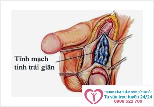 Giãn tĩnh mạch thừng tinh làm tăng tỉ lệ hiếm muộn ở nam giới