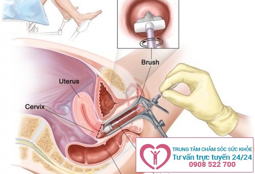 Phương pháp nội soi tử cung