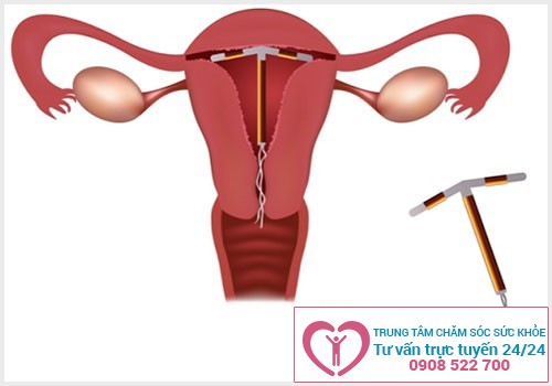 Hình ảnh vòng tránh thai được đặt vào tử cung của nữ giới