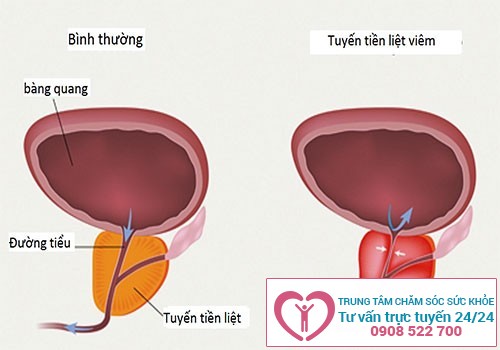 Viêm tuyến tiền liệt cũng khiến cho nước tiểu đục