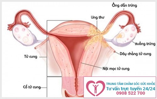 Hình ảnh minh họa bệnh viêm nội mạc tử cung