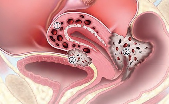 Liệu hình ảnh siêu âm lạc nội mạc tử cung có giúp chẩn đoán bệnh chính xác