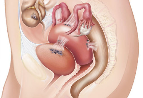 Cảnh báo nguy hiểm từ lạc nội mạc tử cung buồng trứng và cách điều trị