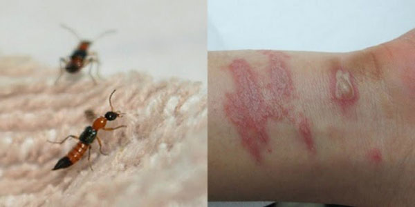 Kiến ba khoang cắn gây những vết phỏng rát kéo dài trên da